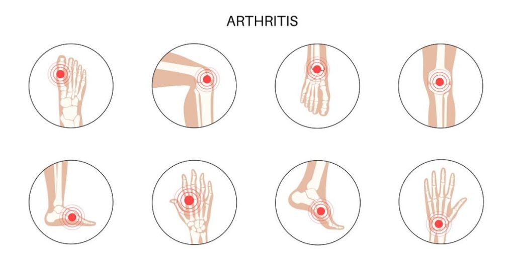 revmatoidni artritis
