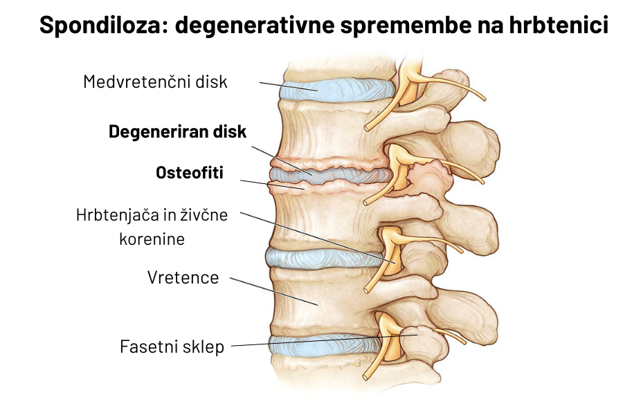 Spondiloza oz. anatomski prikaz degenerativnih sprememb na hrbtenici